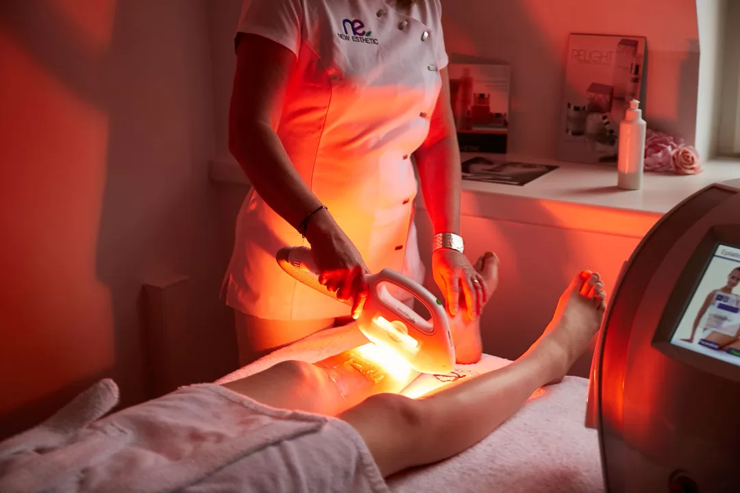 Épilation définitive à l'E-Light chez New Esthetic